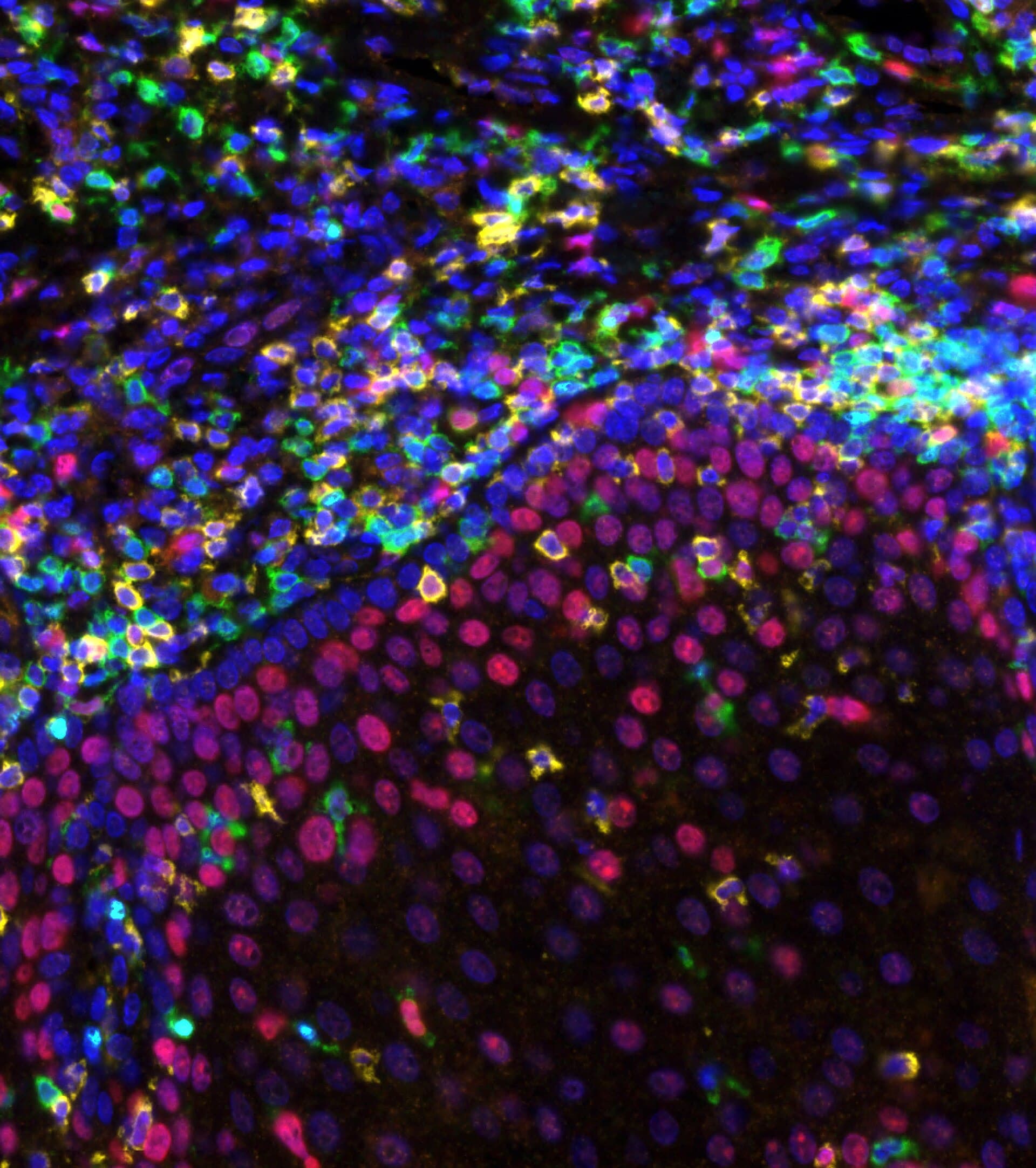 Fluorescence microscopy of a tumour: blue nuclei, magenta tumour-cell nuclei and green and yellow immune cells including T cells gathered at the tumour edge.