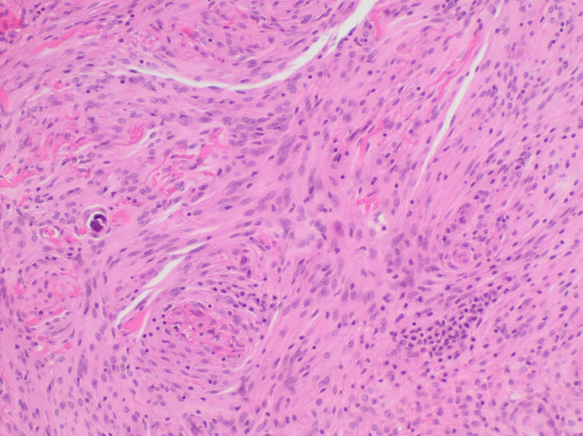 Microscope view of pink and purple stained tissue with swirling cell patterns.